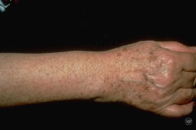主页 特色诊疗 其他皮肤病  日光性雀斑样痣表现为直径数毫米至10 cm
